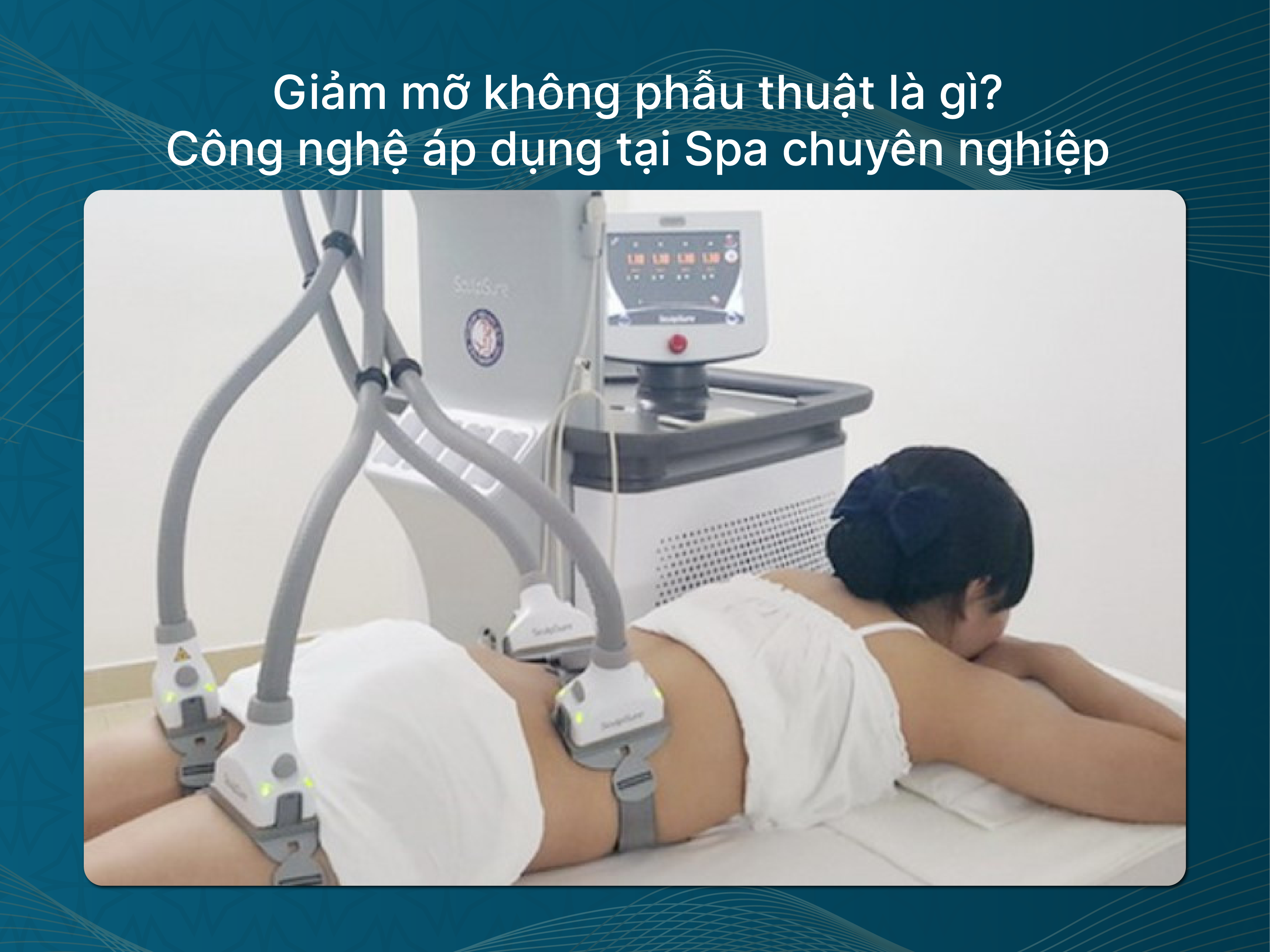 Giảm mỡ không phẫu thuật là gì? Công nghệ áp dụng tại Spa chuyên nghiệp